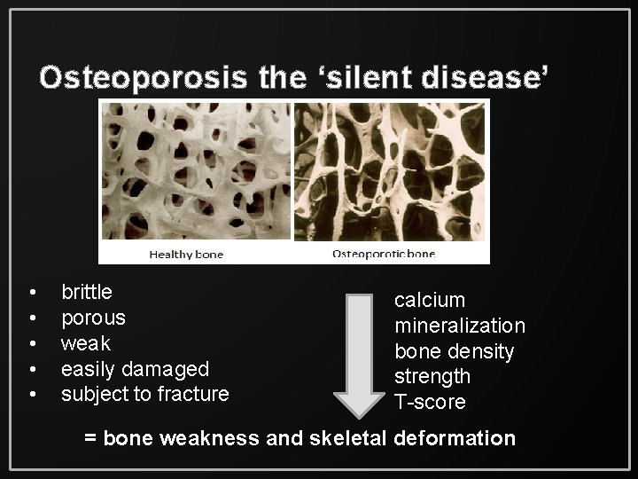 Osteoporosis the ‘silent disease’ • • • brittle porous weak easily damaged subject to