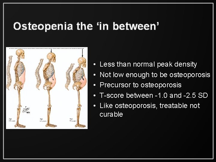 Osteopenia the ‘in between’ • • • Less than normal peak density Not low