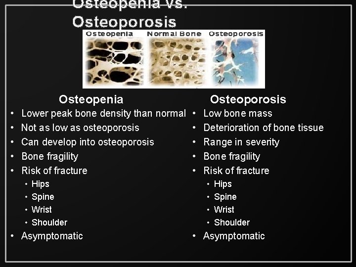 Osteopenia vs. Osteoporosis Osteopenia • • • Lower peak bone density than normal Not