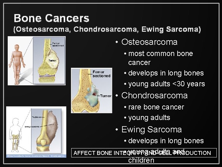 Cancer Exercise Bone Health Beyond the Break 