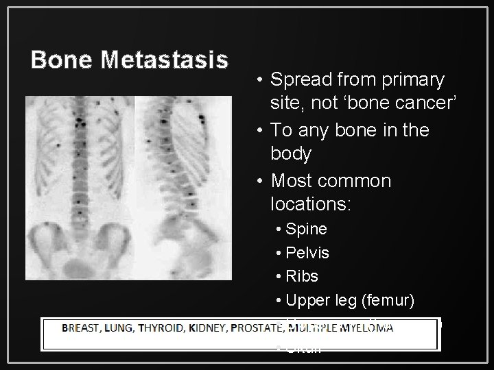 Bone Metastasis • Spread from primary site, not ‘bone cancer’ • To any bone