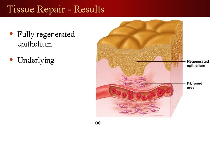 Tissue Repair - Results • Fully regenerated epithelium • Underlying _________ 