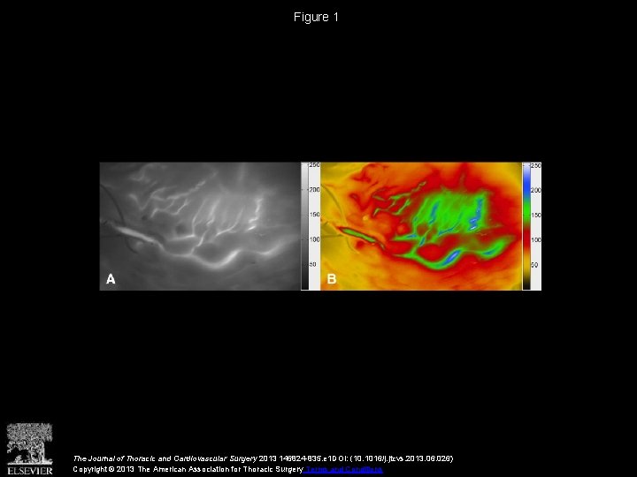 Figure 1 The Journal of Thoracic and Cardiovascular Surgery 2013 146824 -835. e 1