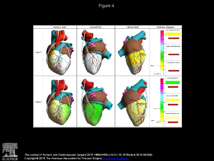 Figure 4 The Journal of Thoracic and Cardiovascular Surgery 2013 146824 -835. e 1