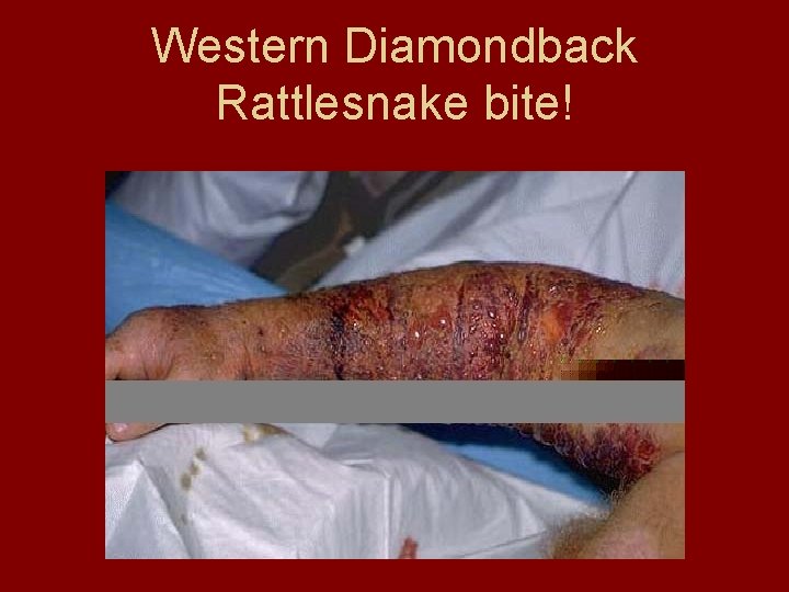 Western Diamondback Rattlesnake bite! 