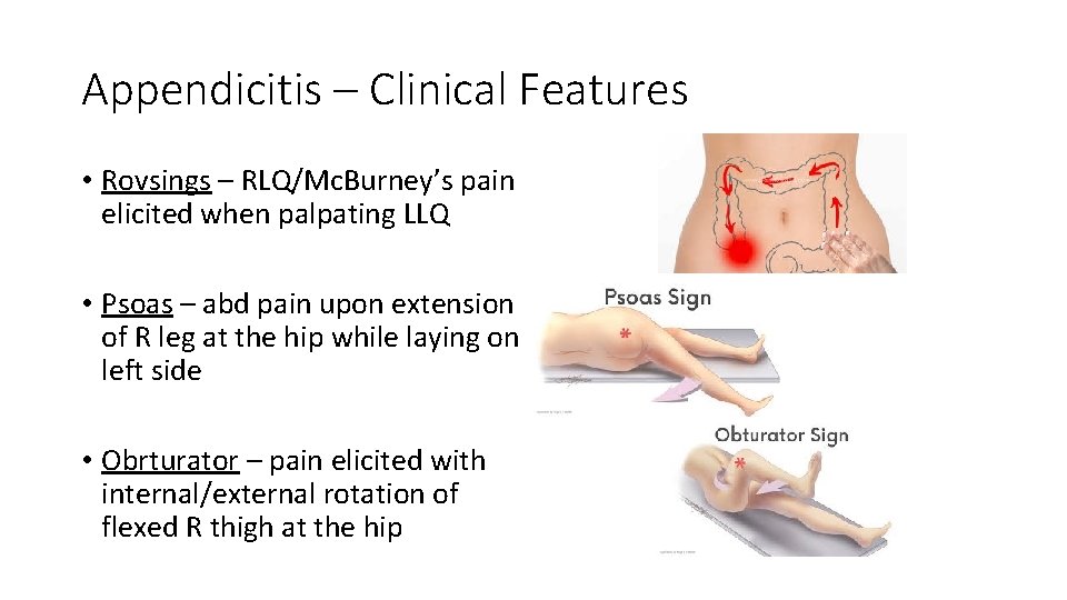 Appendicitis – Clinical Features • Rovsings – RLQ/Mc. Burney’s pain elicited when palpating LLQ