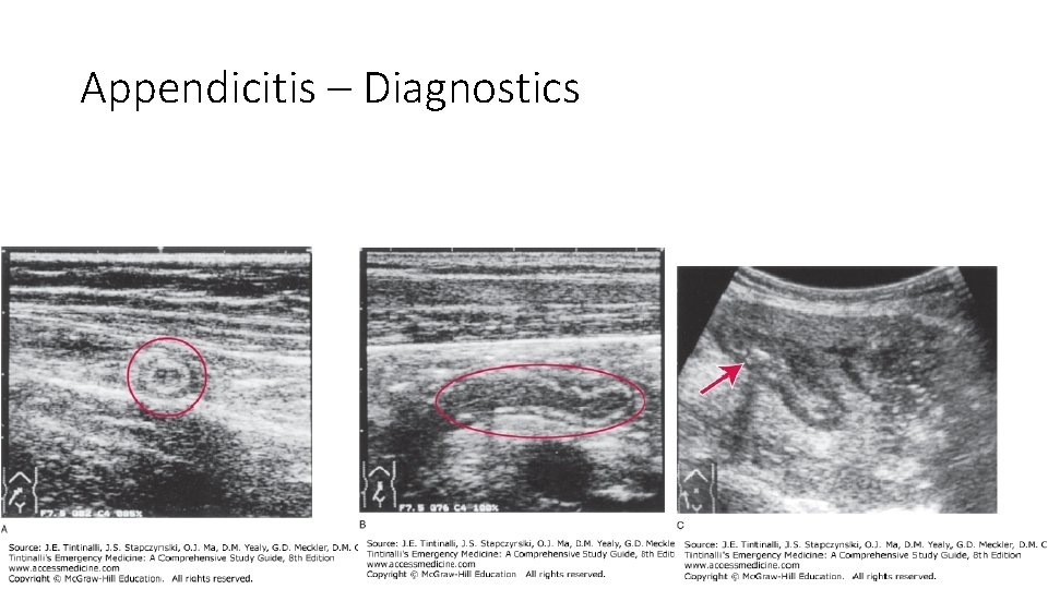 Appendicitis – Diagnostics 