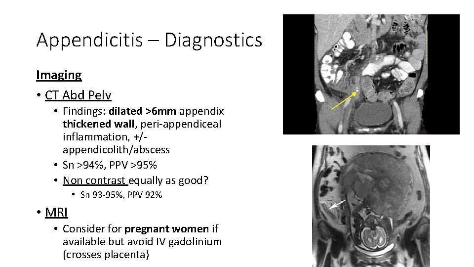 Appendicitis – Diagnostics Imaging • CT Abd Pelv • Findings: dilated >6 mm appendix