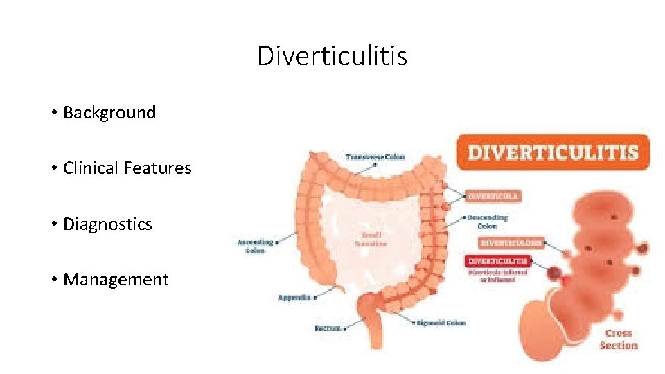 Diverticulitis • Background • Clinical Features • Diagnostics • Management 