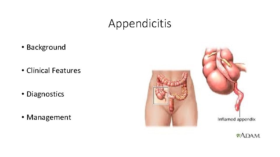 Appendicitis • Background • Clinical Features • Diagnostics • Management 