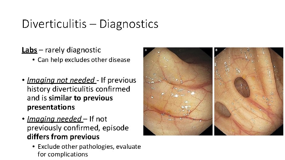 Diverticulitis – Diagnostics Labs – rarely diagnostic • Can help excludes other disease •