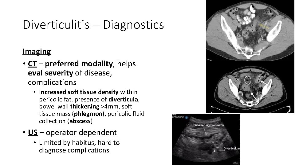 Diverticulitis – Diagnostics Imaging • CT – preferred modality; helps eval severity of disease,