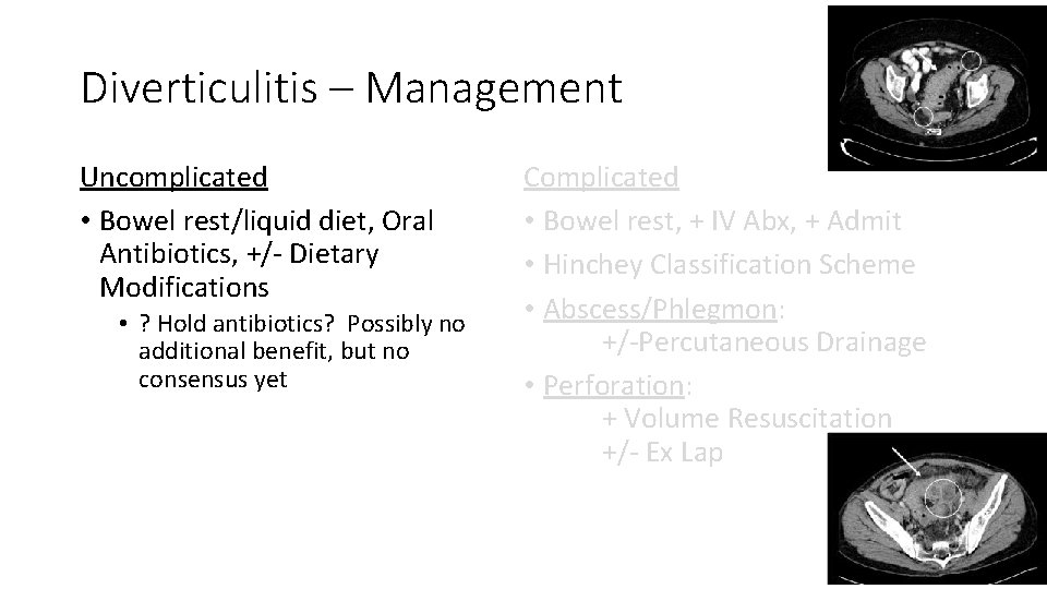 Diverticulitis – Management Uncomplicated • Bowel rest/liquid diet, Oral Antibiotics, +/- Dietary Modifications •