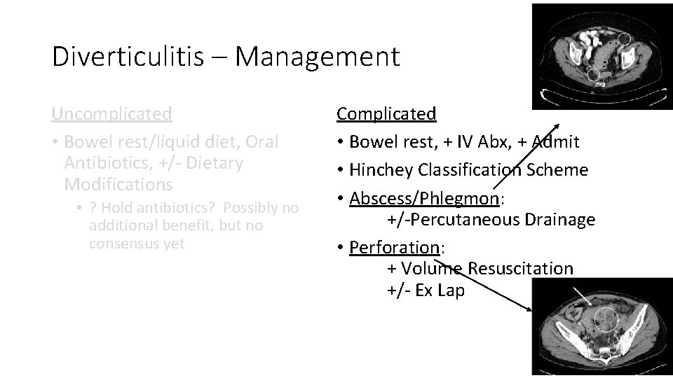 Diverticulitis – Management Uncomplicated • Bowel rest/liquid diet, Oral Antibiotics, +/- Dietary Modifications •