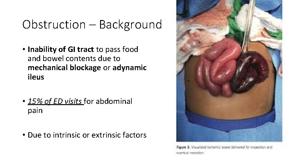 Obstruction – Background • Inability of GI tract to pass food and bowel contents