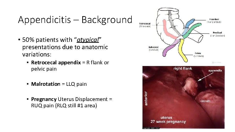 Appendicitis – Background • 50% patients with “atypical” presentations due to anatomic variations: •