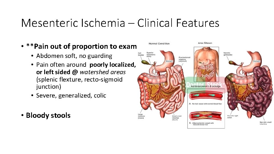 Mesenteric Ischemia – Clinical Features • **Pain out of proportion to exam • Abdomen