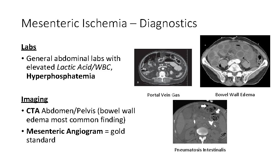 Mesenteric Ischemia – Diagnostics Labs • General abdominal labs with elevated Lactic Acid/WBC, Hyperphosphatemia