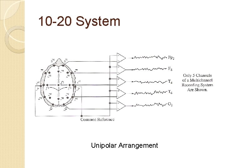 10 -20 System Unipolar Arrangement 