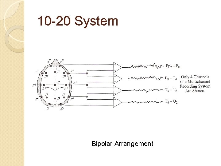 10 -20 System Bipolar Arrangement 