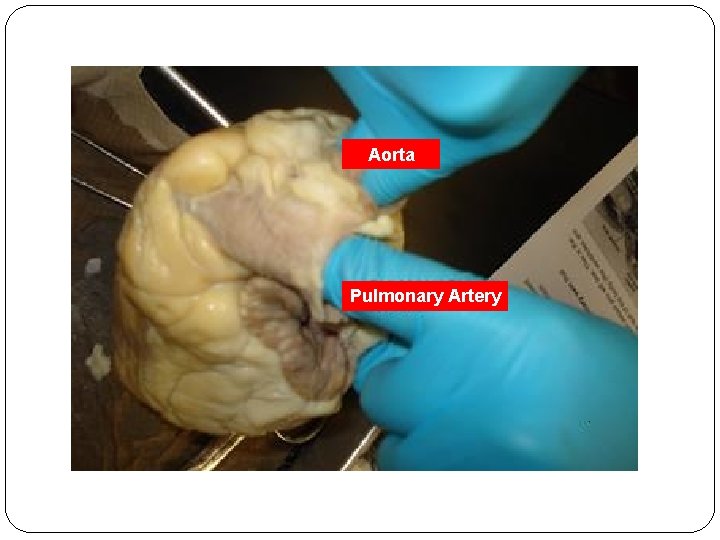 Aorta Pulmonary Artery 