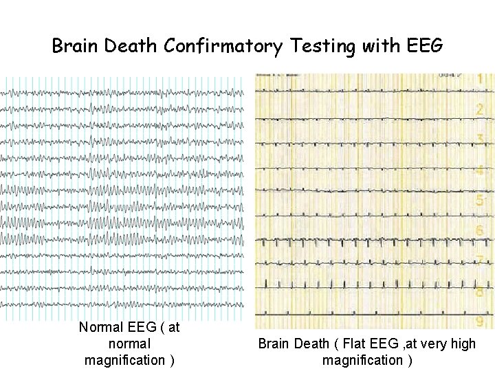 Brain Death Confirmatory Testing with EEG Normal EEG ( at normal magnification ) Brain