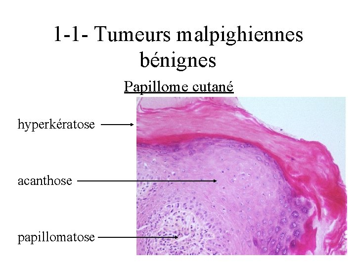 1 -1 - Tumeurs malpighiennes bénignes Papillome cutané hyperkératose acanthose papillomatose 
