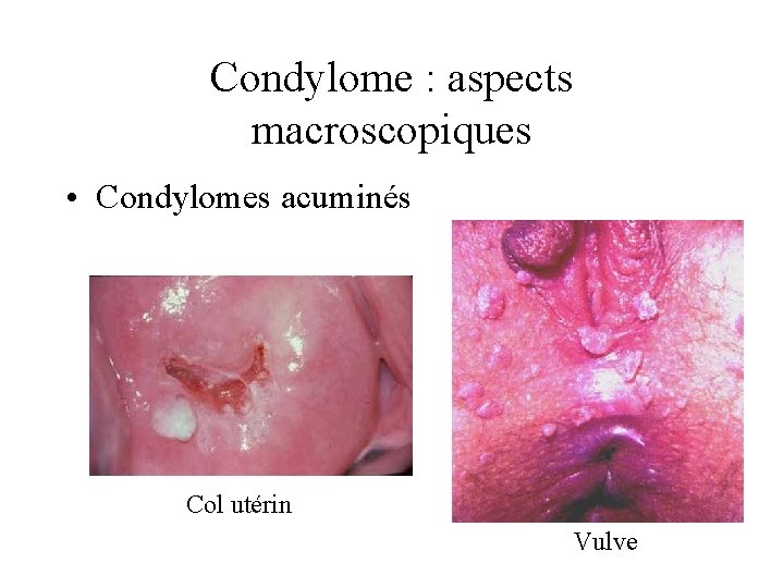 Condylome : aspects macroscopiques • Condylomes acuminés Col utérin Vulve 