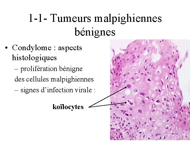 1 -1 - Tumeurs malpighiennes bénignes • Condylome : aspects histologiques – prolifération bénigne