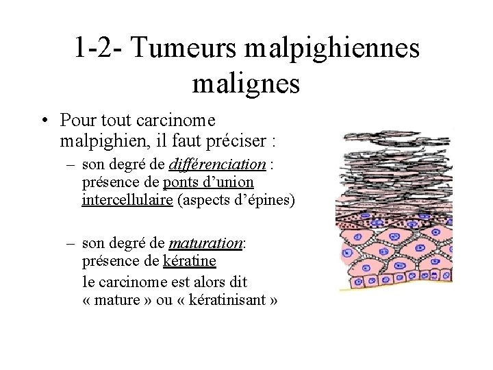 1 -2 - Tumeurs malpighiennes malignes • Pour tout carcinome malpighien, il faut préciser