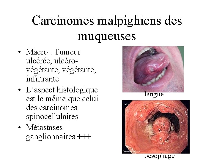Carcinomes malpighiens des muqueuses • Macro : Tumeur ulcérée, ulcérovégétante, infiltrante • L’aspect histologique