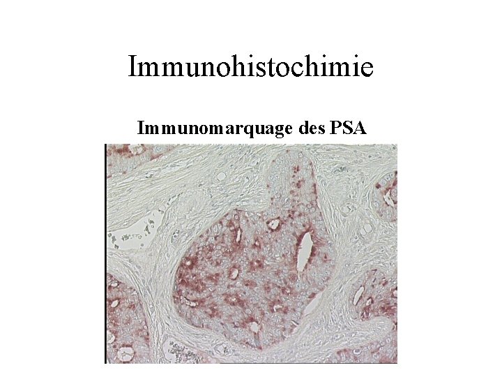 Immunohistochimie Immunomarquage des PSA 