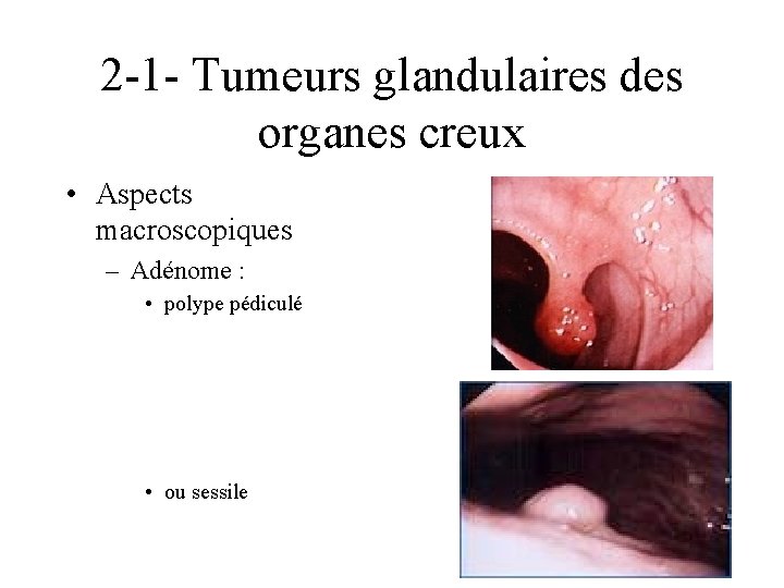 2 -1 - Tumeurs glandulaires des organes creux • Aspects macroscopiques – Adénome :