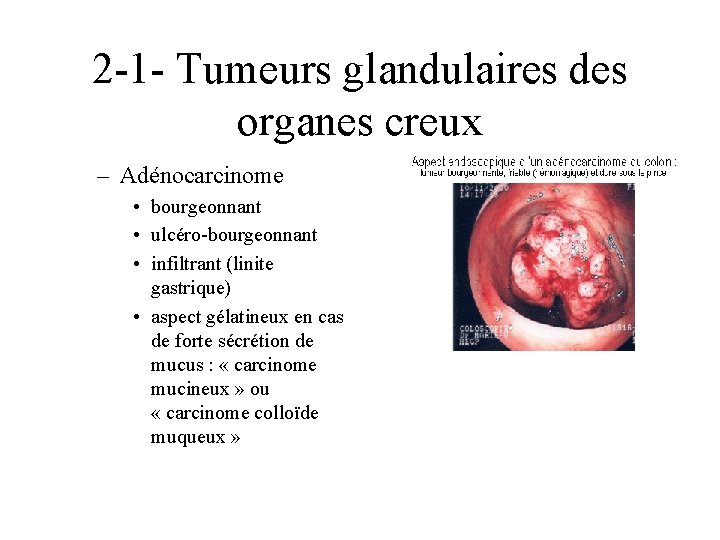 2 -1 - Tumeurs glandulaires des organes creux – Adénocarcinome • bourgeonnant • ulcéro-bourgeonnant