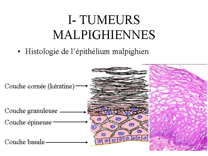 I- TUMEURS MALPIGHIENNES • Histologie de l’épithélium malpighien Couche cornée (kératine) Couche granuleuse Couche