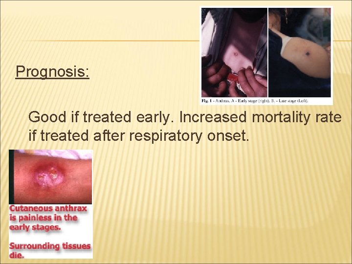 Prognosis: Good if treated early. Increased mortality rate if treated after respiratory onset. 