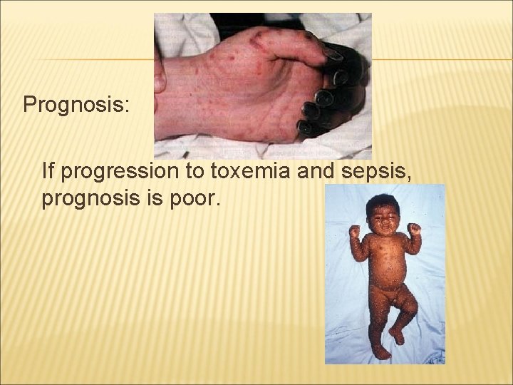 Prognosis: If progression to toxemia and sepsis, prognosis is poor. 