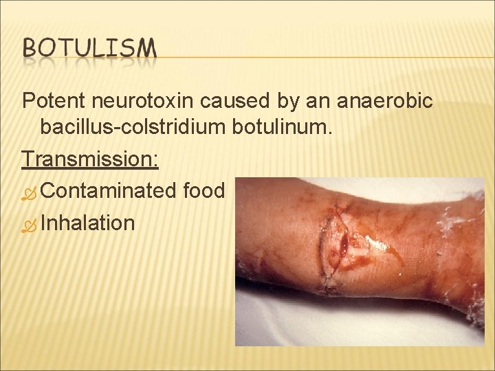 Potent neurotoxin caused by an anaerobic bacillus-colstridium botulinum. Transmission: Contaminated food Inhalation 