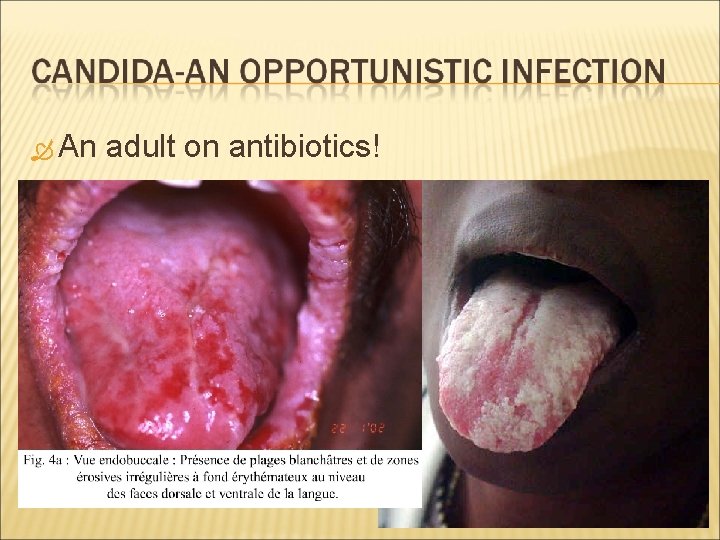  An adult on antibiotics! 