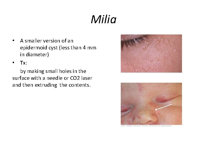 Milia • A smaller version of an epidermoid cyst (less than 4 mm in