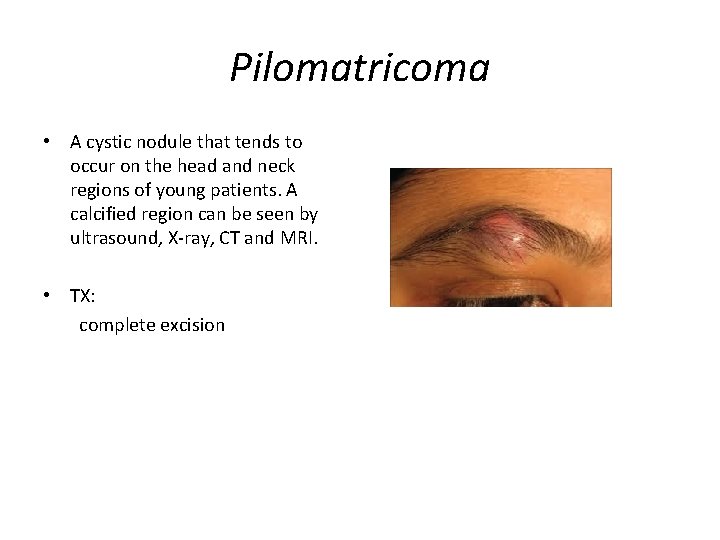 Pilomatricoma • A cystic nodule that tends to occur on the head and neck