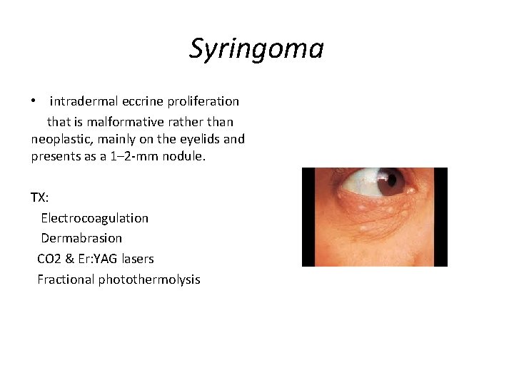 Syringoma • intradermal eccrine proliferation that is malformative rather than neoplastic, mainly on the