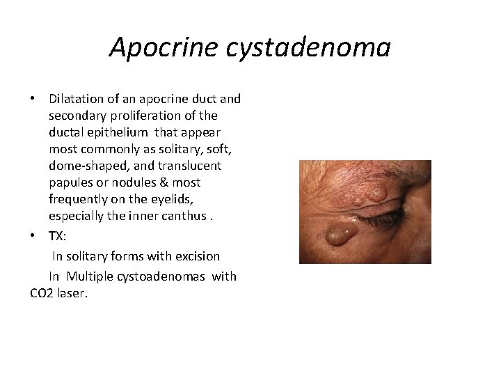 Apocrine cystadenoma • Dilatation of an apocrine duct and secondary proliferation of the ductal