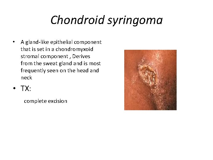 Chondroid syringoma • A gland-like epithelial component that is set in a chondromyxoid stromal
