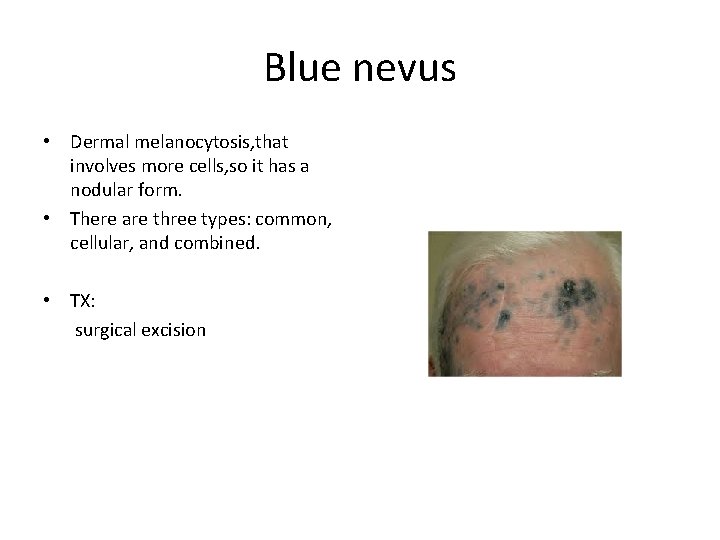 Blue nevus • Dermal melanocytosis, that involves more cells, so it has a nodular