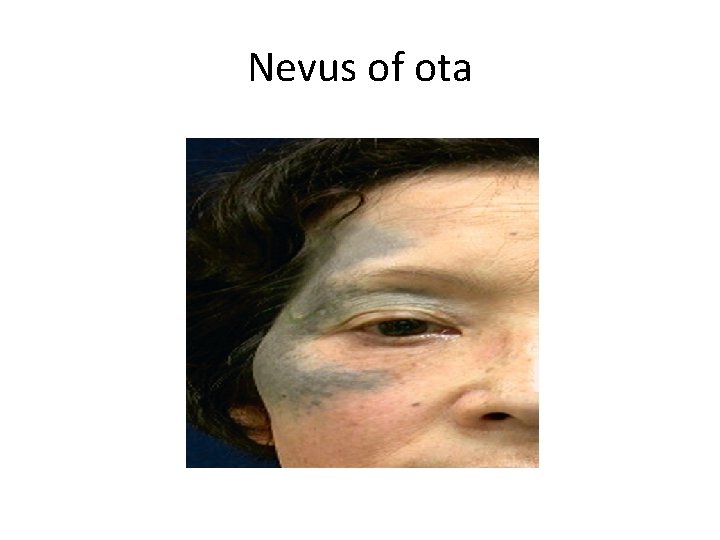 Nevus of ota 