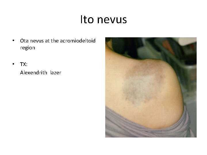 Ito nevus • Ota nevus at the acromiodeltoid region • TX: Alexendrith lazer 