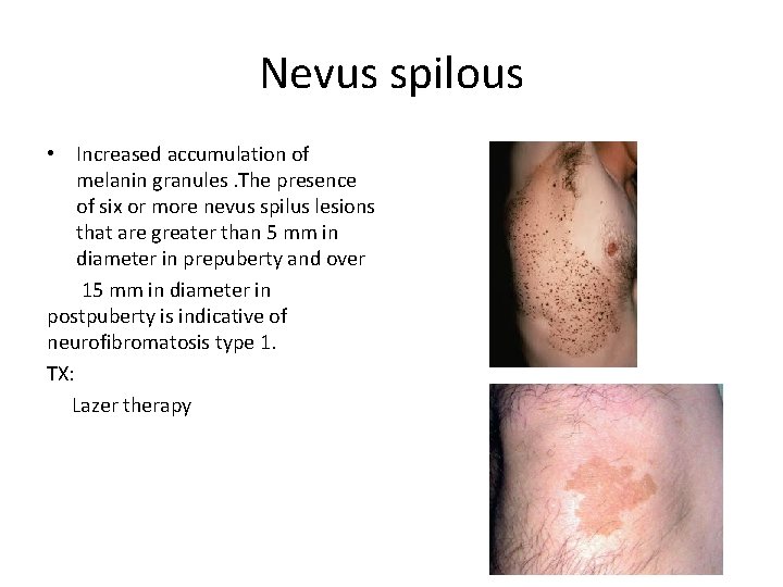 Nevus spilous • Increased accumulation of melanin granules. The presence of six or more