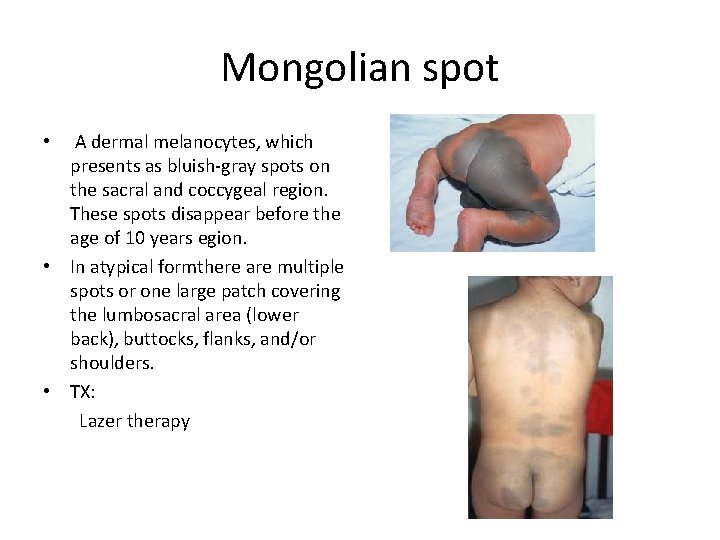 Mongolian spot A dermal melanocytes, which presents as bluish-gray spots on the sacral and