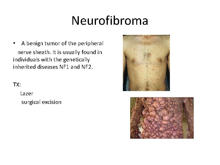 Neurofibroma • A benign tumor of the peripheral nerve sheath. It is usually found